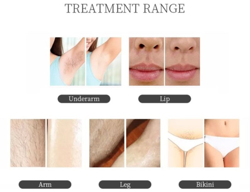 Effective 2in1 808 Diode Laser Hair Removal Nd Yag Tattoo Removal For Home