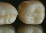 Translucent Natural Looking Zirconia dental Crown with Excellent Durability and