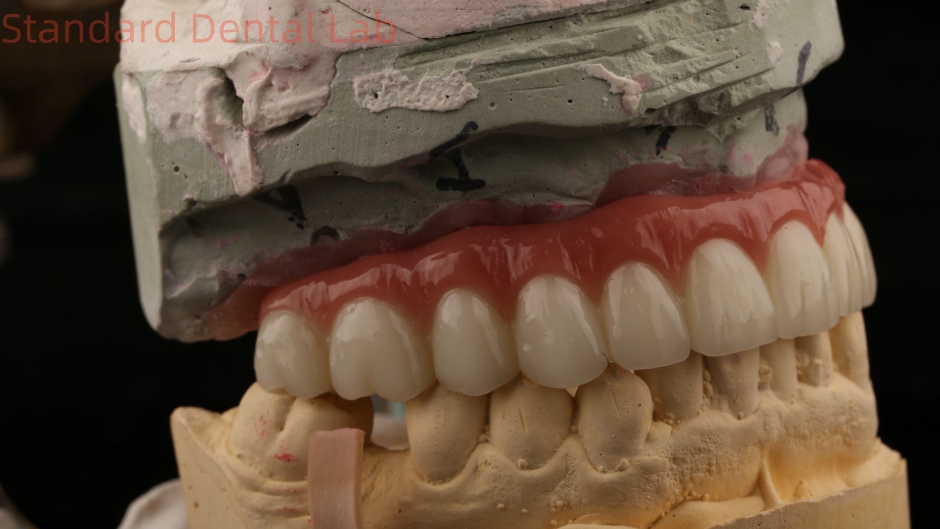 Hybrid Titanium Screw Retained Dental Implant Crown All On 4 Dental Implant Zirconia Bridge