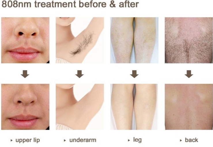 Diode Laser Beauty Equipment 755 808 1064 Hair Removal Skin Rejuvenation
