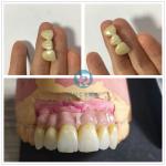 CAD CAM Translucent Zirconia Crowns 98mm HT Zirconia Blank Disc