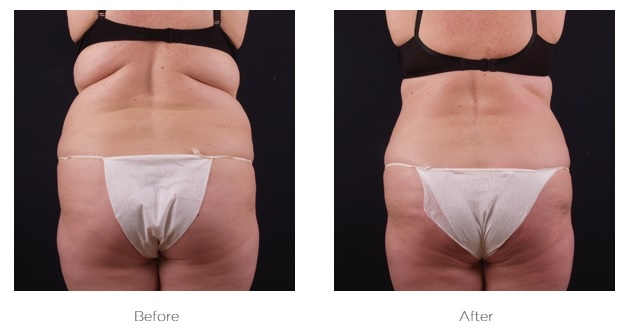 Elite Ultra 360_Before_and_AFter_Abdomen