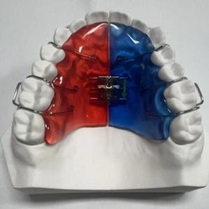 China Stainless Steel Acrylic Screw Expander Orthodontic Treatment Removable wholesale