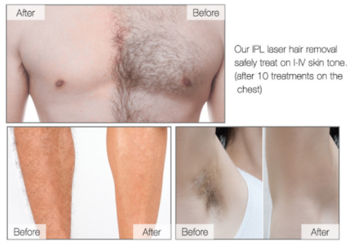 OEM 240V IPL Hair Removal Device Intense Pulse Light Technology