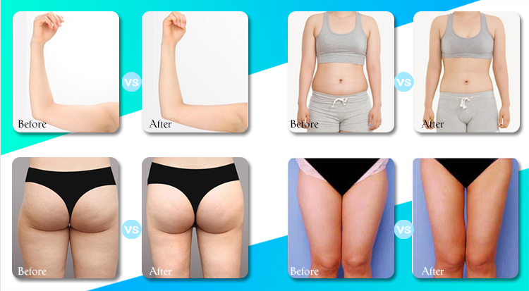 Body Shaper Slim Equipment Professional Ultra Lifting Face And Body