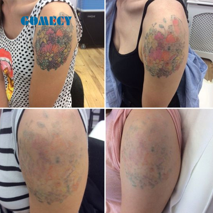Energy Max 2000mj Aiming Beam Guided By Red Light Tattoo Removal Machine for Your Requirements