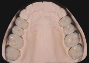 China Dental Restoration Teeth Zirconia dental Crowns crafted by china dental lab wholesale