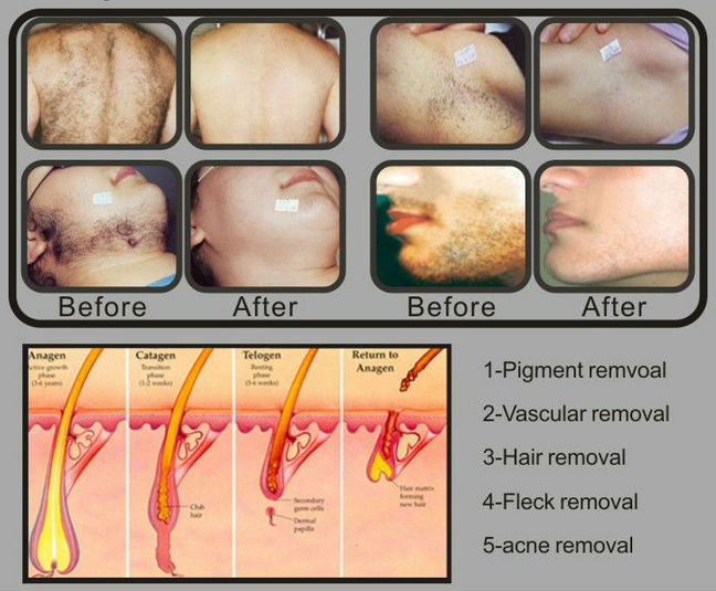 2018 Hottest wholesale HR SR two probe stainless head ipl hair removal machine