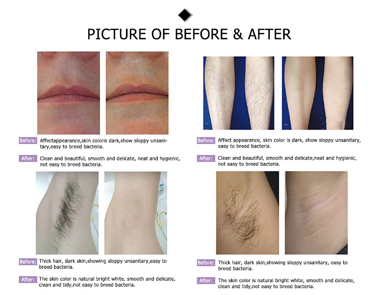 professional best 808nm alexandrite alex commercial facial prices diode hair removal laser machine for sale
