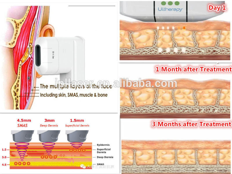 Foreye Week Tightening Skin Lifting Machine Medical 5 Cartridge