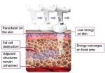 2015 most advanced professional HIFUSlim body slimming cavitation hifu