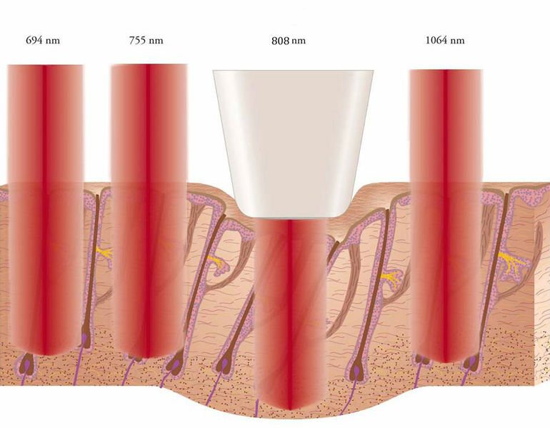 Micro Channel IPL Permanent Hair Reduction for Women / Ladies 808nm Wavelength