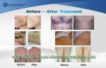 TEC + Water + Air Cooling 808nm Diode Laser Hair Removal Machine Fast Speed and
