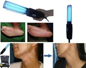China Psoriasis Uvb 311nm Phototherapy 200V Uvb Vitiligo Lamp wholesale