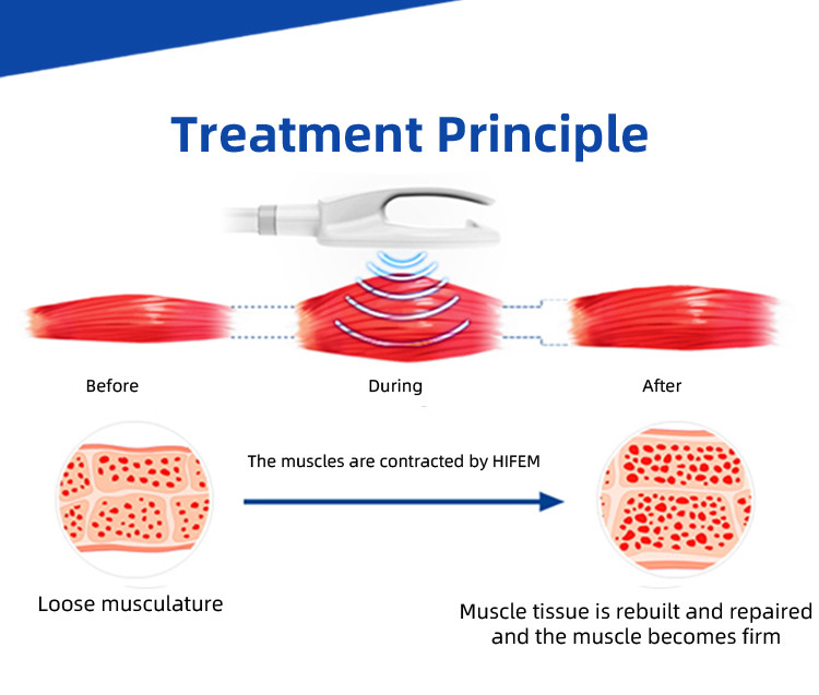 HI-EMT 7 Tesla EMS Sculpting Machine: Build Muscle Fast and Non-Invasively