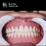 Resin Teeth Dental Titanium Bar Removable Blue Sky Implant System