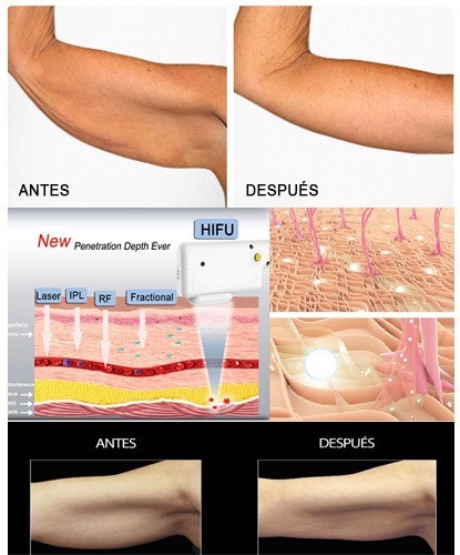 4D Hifu Non Surgical Face Lift Equipment