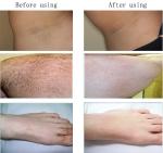 Best permanent hair removal laser ipl SHR machine