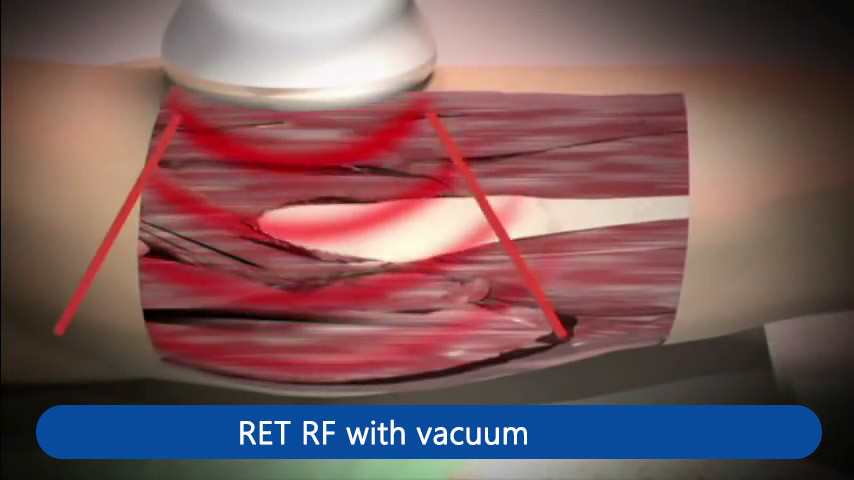448khz Tecar Therapy Machine Vacuum Cet Ret RF Monopolar Pain Relief Human Pets Physiotherapy