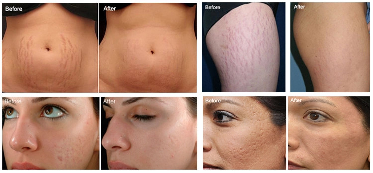 Microneedling Skin Tightening Radio Frequency Machine 2Mhz Therapeutic Medical Equipment