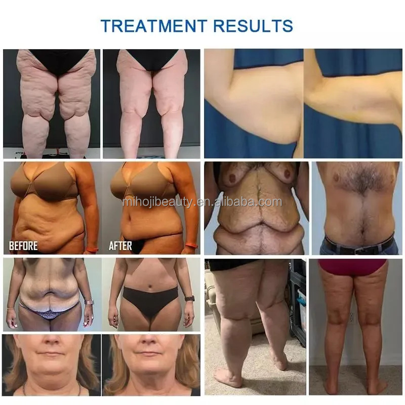 5 Handles Cryolipolysis Slimming Machine Body RF With LCD Display