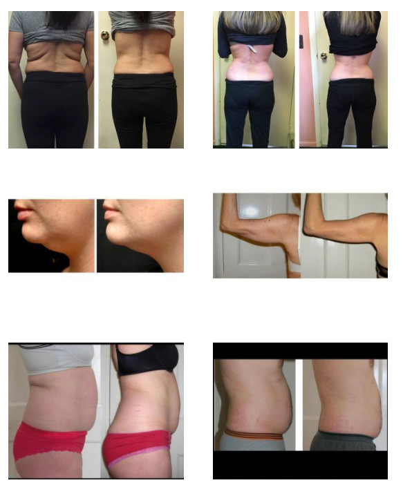 40KHz Cavitation Handle Cryolipolysis Slimming Machine RF Cavitation