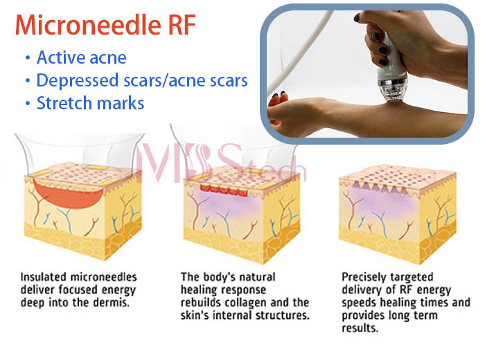spa 4MHz 10 Pins Skin Tighten Micro Needle Rf Machine