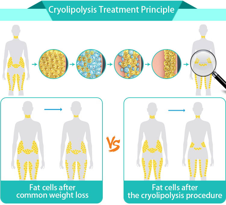 Beauty equipment manufacturer body slimming machine 4 cryo handles cryolipolysis