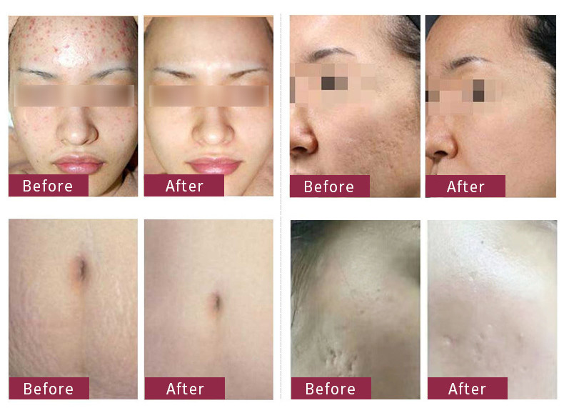 400mj CO2 Fractional Laser Machine 60W female intimate areal Rejuvenation Machine