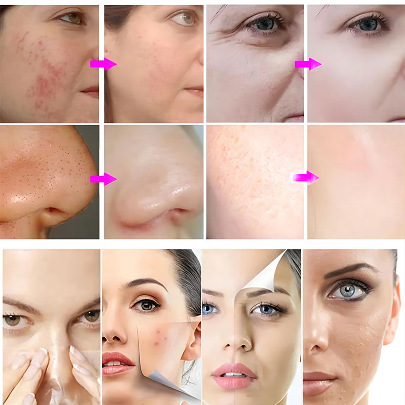 Hydro Water Professional Hydrodermabrasion Machine for Skin Rejuvenation
