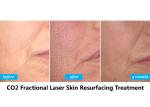 Safety CO2 Acne Scar Removal Machine , Carbon Dioxide Laser Resurfacing Machine