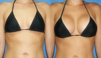 Lips Enhance Hyaluronic Acid Facial Filler With 0.10 - 0.15mm Particle Size