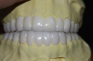 China Temporary PFM Dental Crown wholesale