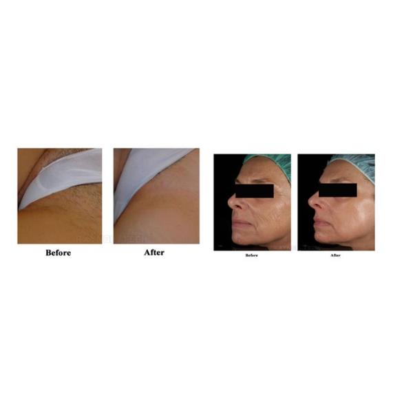 690 - 1200nm IPL Beauty Equipment