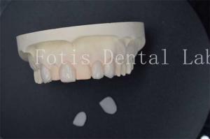 China Custom Artificial Dental Lab Veneers With Superior Stain Resistance wholesale