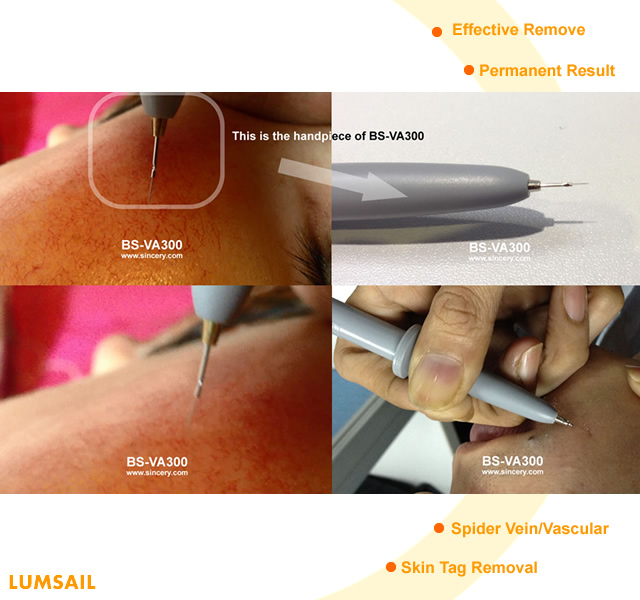 vascular removal