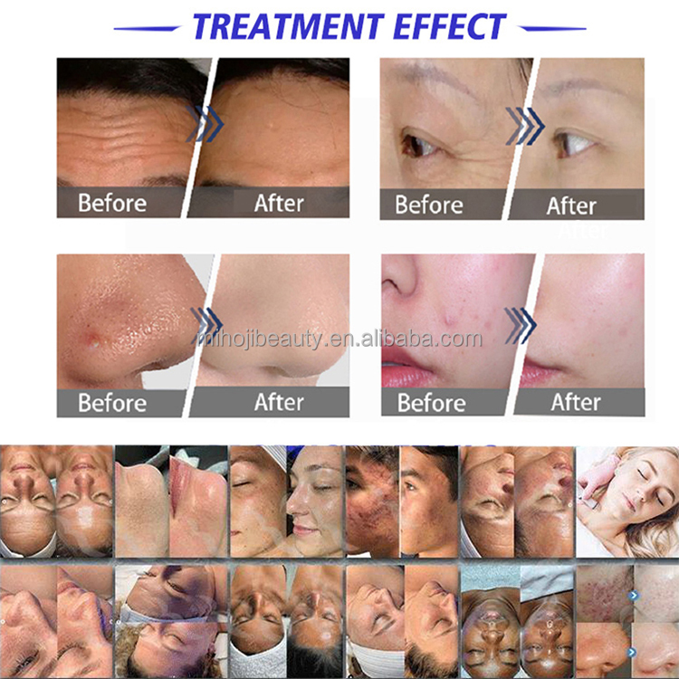 Hydro Water Professional Hydrodermabrasion Machine for Skin Rejuvenation