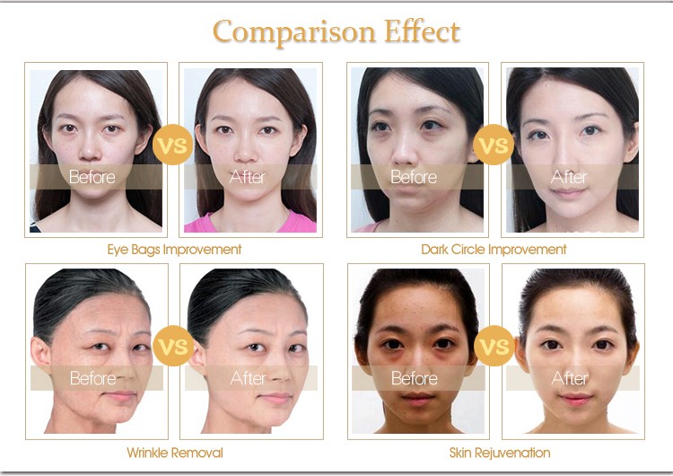 RF Removing Eye Bags Machine Under Eye Dark Circle Removal 630nm Infrared Wave
