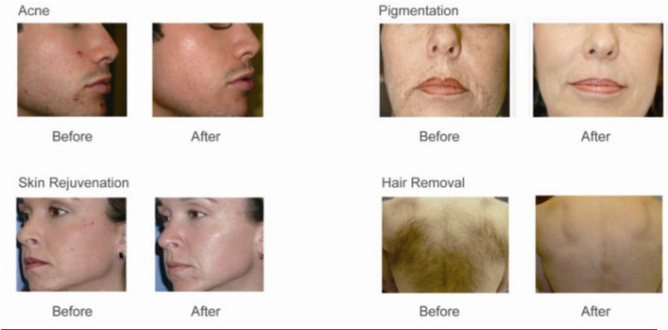 Portable High Frequency 980nm Diode Laser Machine For Skin Tags Removal