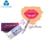 Juvederm Ultra 3 Hyaluronic Acid Dermal Filler For Face Lips