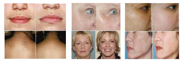 elight hair removal.jpg