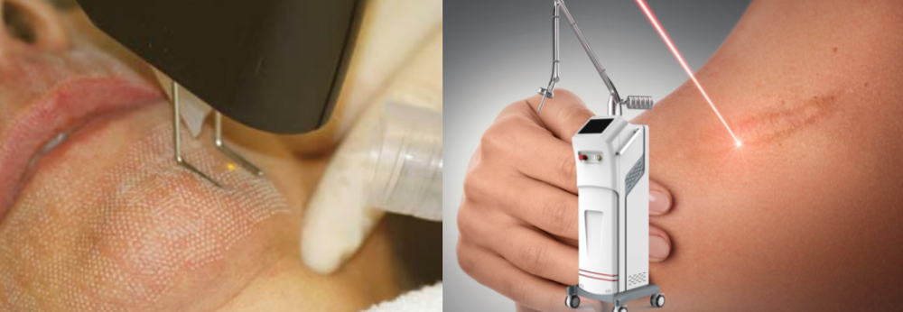 Clinic Salon Portable CO2 Fractional Laser Machine Beauty Salon Equipment For Acne Removal