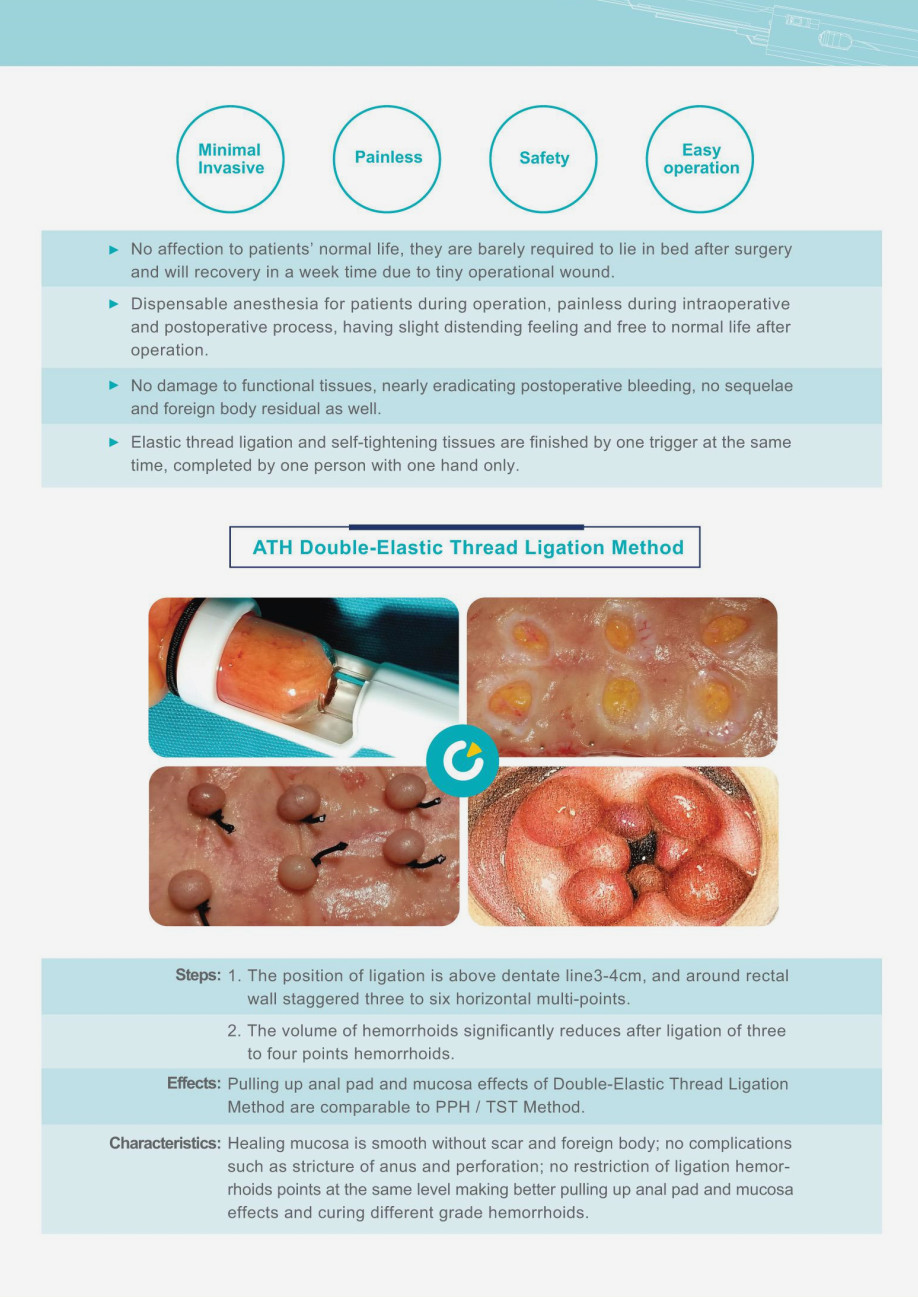 Automatic Hemorrhoid Removal Without Surgery , Internal Piles Treatment Curved Intraluminal Stapler