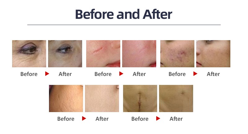 RF Fractional Co2 Laser Machine 4D Skin Resurfacing For Acne Treatment