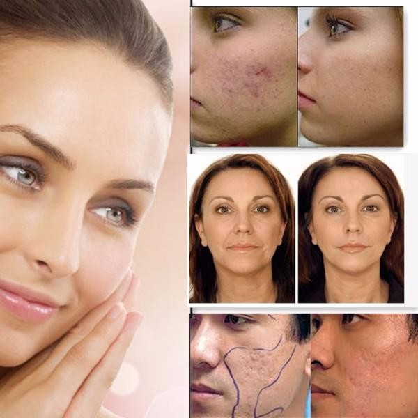 China Manufacturer PDT LED Light Skin Beauty Machine