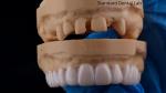 High Esthetics Dental Snap On Smile Standard Dental Lab Removable Dental
