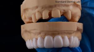 China High Esthetics Dental Snap On Smile Standard Dental Lab Removable Dental Appliance wholesale