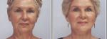 korea best rf stomach laser skin tightening stomach wave ferquency device