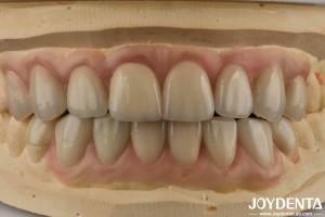 China High Translucency Emax Cosmetic Dentistry Veneers High Aesthetics Ultra Thin wholesale