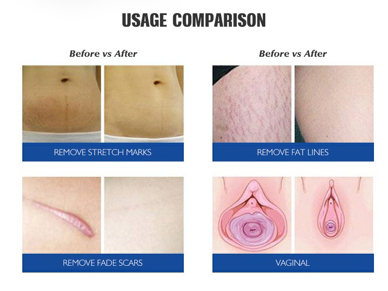 Q Switched Fractional Co2 Laser Skin Resurfacing Machine 10600nm